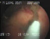 STENT012