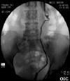 STENT014