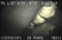 STENT017